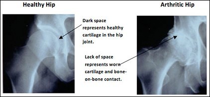 Hip Pain Diagnosis, Rockville, Maryland - Diagnosis of Hip Joint, Hip ...